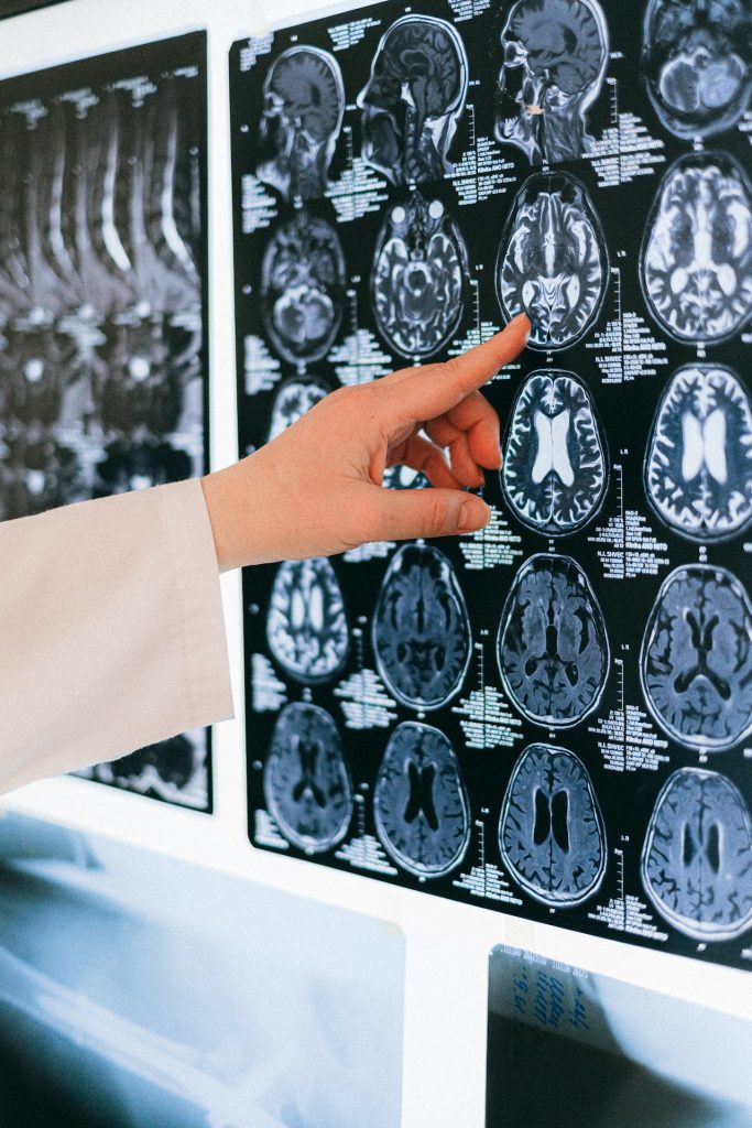 medical professional pointing at an MRI chart