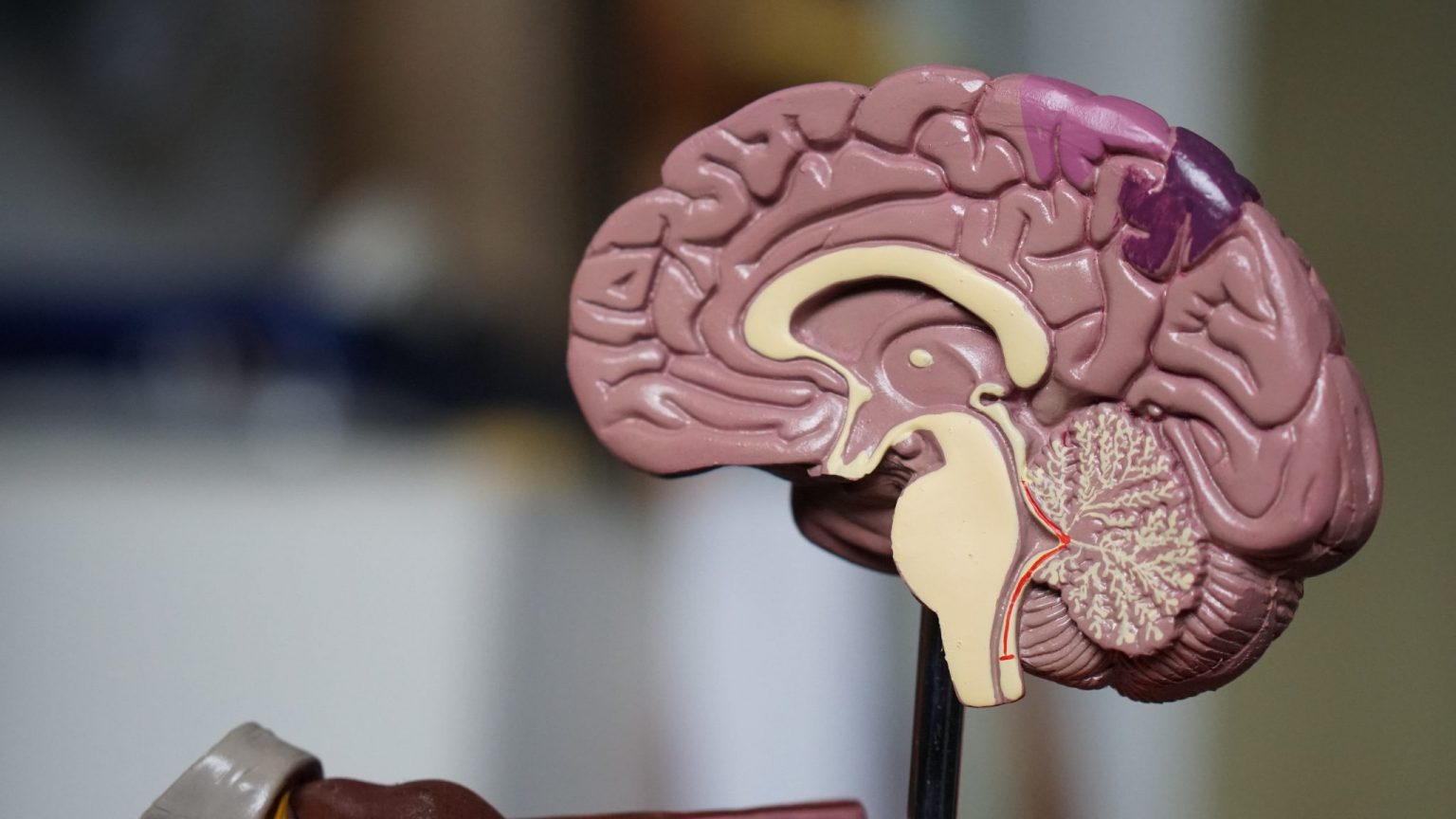What is wet brain about wernicke korsakoff syndrome ria health