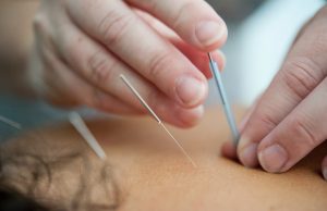 hand inserting acupuncture needles